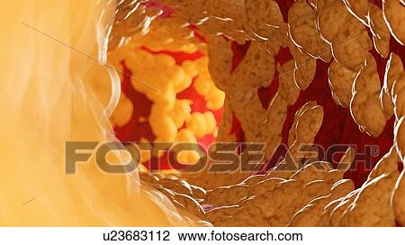 Stock Image - Illustration of fat inside of an artery.. Fotosearch