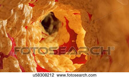 Stock Image - Illustration of fat inside of an artery.. Fotosearch