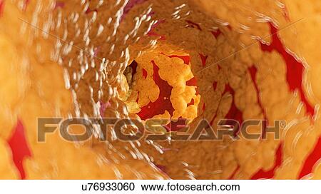 Stock Image - Illustration of fat inside of an artery.. Fotosearch