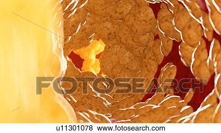 Stock Photo - Illustration of fat inside of an artery.. Fotosearch