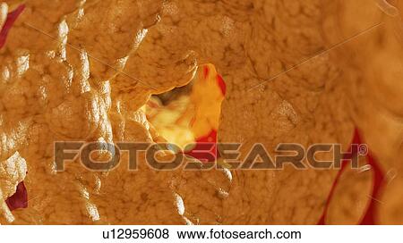 Stock Photo - Illustration of fat inside of an artery.. Fotosearch