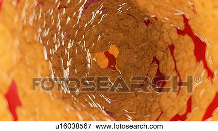 Stock Photo - Illustration of fat inside of an artery.. Fotosearch