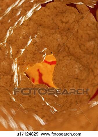 Stock Photo - Illustration of fat inside of an artery.. Fotosearch