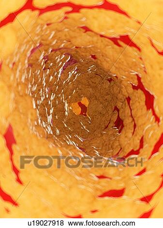 Illustration of fat inside of an artery. View Large Photo Image Stock Photo - Illustration of fat inside of an artery.. Fotosearch