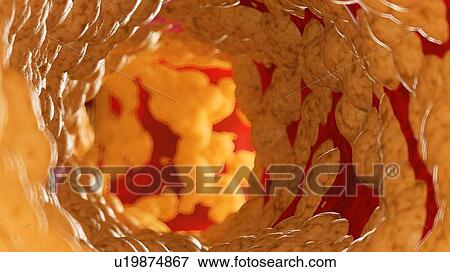 Illustration of fat inside of an artery. View Large Photo Image Stock Photo - Illustration of fat inside of an artery.. Fotosearch