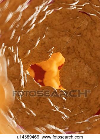 Stock Photograph - Illustration of fat inside of an artery.. Fotosearch