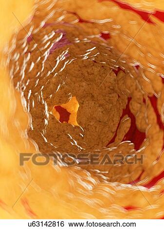 Stock Photograph - Illustration of fat inside of an artery.. Fotosearch