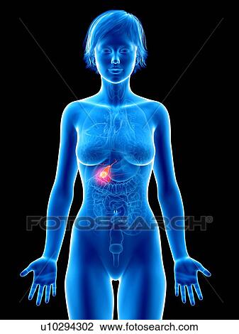 Illustration of gallbladder cancer. View Large Photo Image Stock Image - Illustration of gallbladder cancer.. Fotosearch