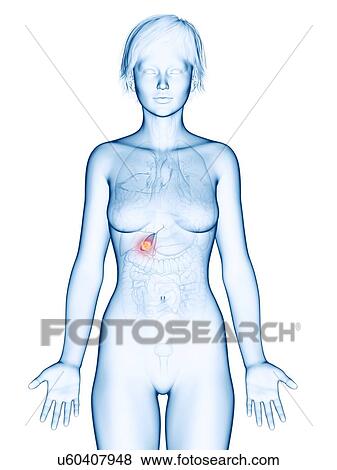 Stock Photo - Illustration of gallbladder cancer.. Fotosearch