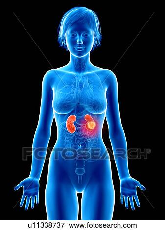 Stock Photo - Illustration of kidneys cancer.. Fotosearch