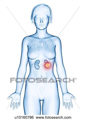Stock Photograph - Illustration of kidneys cancer.. Fotosearch