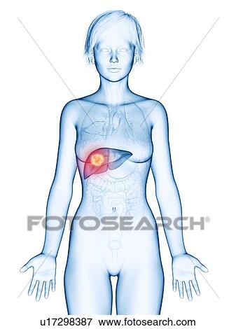 Stock Photo - Illustration of liver cancer.. Fotosearch