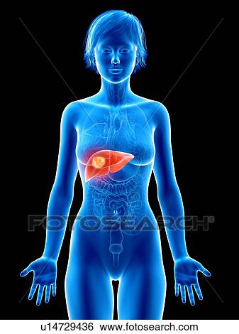 Stock Photograph - Illustration of liver cancer.. Fotosearch