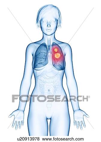 Stock Photo - Illustration of lung cancer.. Fotosearch