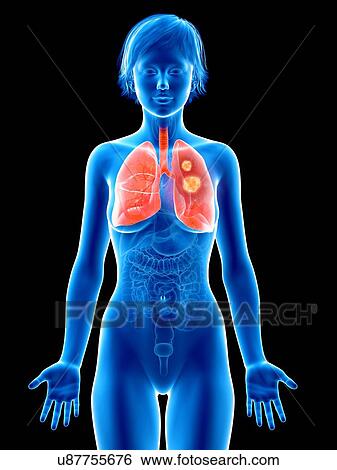 Illustration of lung cancer. View Large Photo Image Stock Photograph - Illustration of lung cancer.. Fotosearch