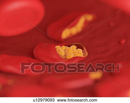 Stock Image - Illustration of malaria infected blood cells.. Fotosearch