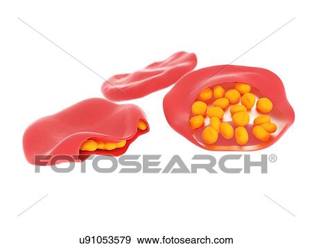 Stock Photo - Illustration of malaria infected blood cells.. Fotosearch