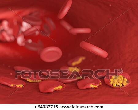 Stock Photography - Illustration of malaria infected blood cells.. Fotosearch