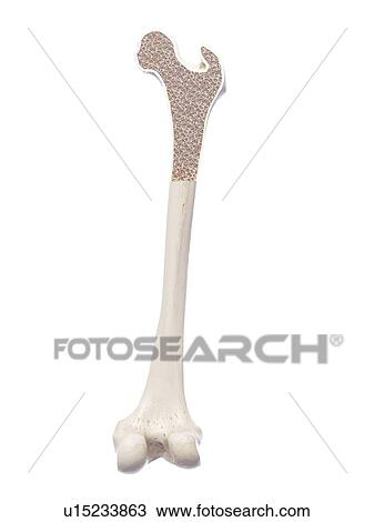 Stock Image - Illustration of osteoporosis.. Fotosearch