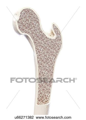 Illustration of osteoporosis. View Large Photo Image Stock Image - Illustration of osteoporosis.. Fotosearch