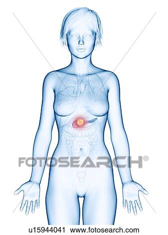 Stock Image - Illustration of pancreas cancer.. Fotosearch