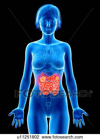 Stock Image - Illustration of small intestine cancer.. Fotosearch