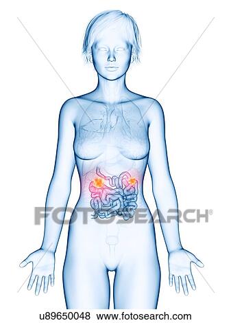 Illustration of small intestine cancer. View Large Photo Image Stock Photo - Illustration of small intestine cancer.. Fotosearch