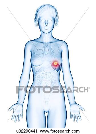 Illustration of spleen cancer. View Large Photo Image Stock Image - Illustration of spleen cancer.. Fotosearch