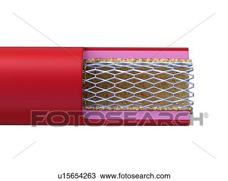 Illustration of stent placed in an artery. View Large Photo Image Stock Image - Illustration of stent placed in an artery.. Fotosearch