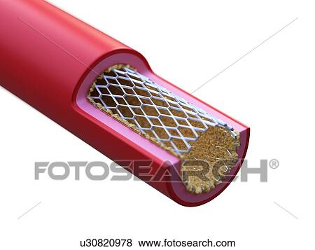 Stock Photo - Illustration of stent placed in an artery.. Fotosearch