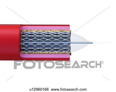 Illustration of stent placed in an artery. View Large Photo Image Stock Photograph - Illustration of stent placed in an artery.. Fotosearch