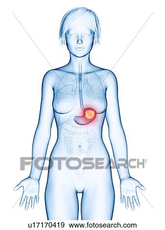 Illustration of stomach cancer. View Large Photo Image Stock Photo - Illustration of stomach cancer.. Fotosearch