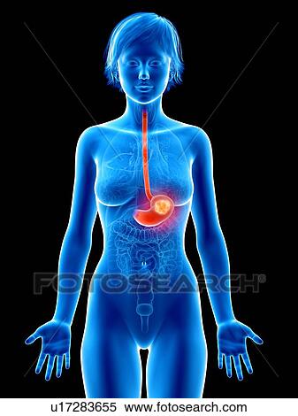 Illustration of stomach cancer. View Large Photo Image Stock Photography - Illustration of stomach cancer.. Fotosearch