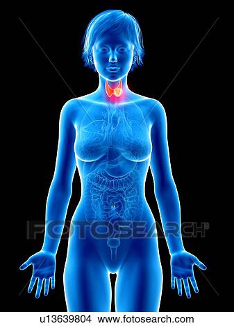 Picture - Illustration of thyroid gland cancer.. Fotosearch
