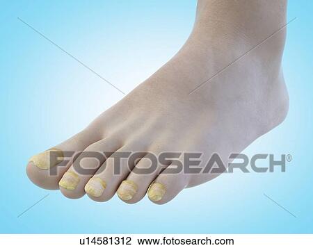 Illustration of toe nail fungus. View Large Photo Image Stock Image - Illustration of toe nail fungus.. Fotosearch