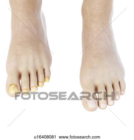 Stock Image - Illustration of toe nail fungus.. Fotosearch