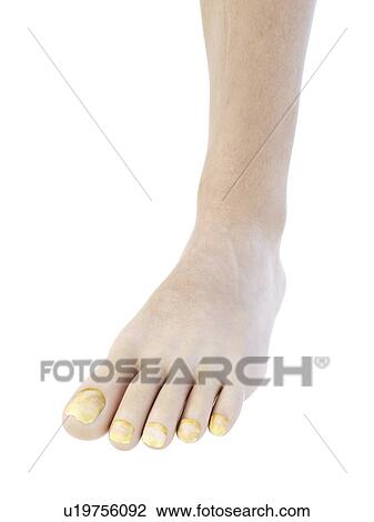 Stock Image - Illustration of toe nail fungus.. Fotosearch