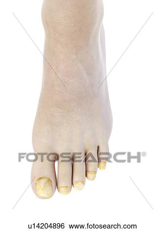 Stock Photograph - Illustration of toe nail fungus.. Fotosearch