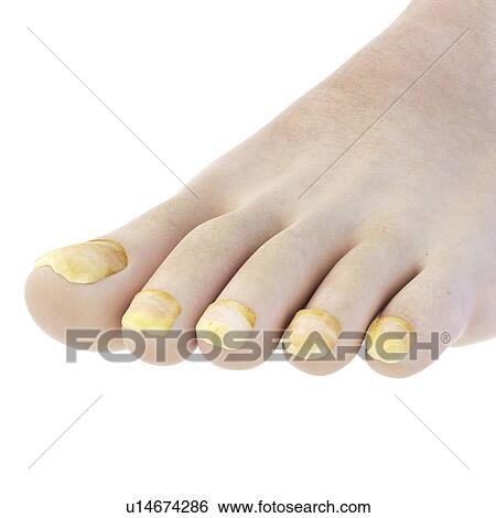 Stock Photograph - Illustration of toe nail fungus.. Fotosearch