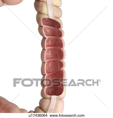Picture - Illustration of tumour growth in the colon.. Fotosearch
