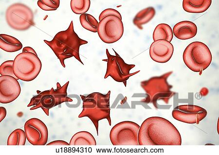 Stock Image - Acanthocyte abnormal red blood cells, illustration. Fotosearch