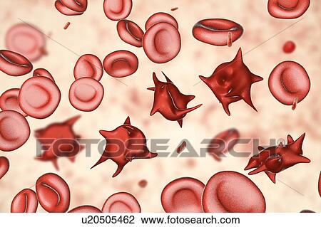 Stock Image - Acanthocyte abnormal red blood cells, illustration. Fotosearch