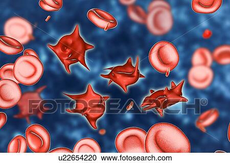 Stock Image - Acanthocyte abnormal red blood cells, illustration. Fotosearch