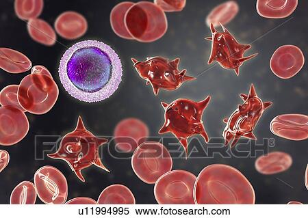 Stock Photography - Acanthocyte abnormal red blood cells, illustration. Fotosearch