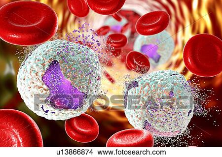 Acute lymphoblastic leukaemia treatment, illustration View Large Photo Image Picture - Acute lymphoblastic leukaemia treatment, illustration. Fotosearch