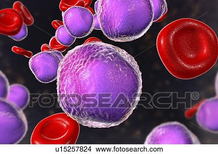 Picture - Acute lymphoblastic leukaemia smear, illustration. Fotosearch