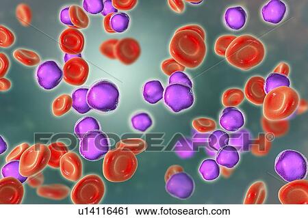 Stock Image - Acute lymphoblastic leukaemia smear, illustration. Fotosearch