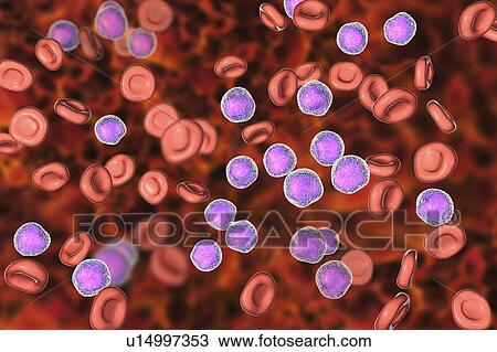 Stock Image - Acute lymphoblastic leukaemia smear, illustration. Fotosearch
