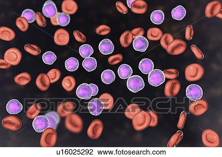 Acute lymphoblastic leukaemia smear, illustration View Large Photo Image Stock Image - Acute lymphoblastic leukaemia smear, illustration. Fotosearch