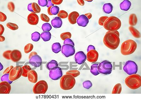 Stock Image - Acute lymphoblastic leukaemia smear, illustration. Fotosearch